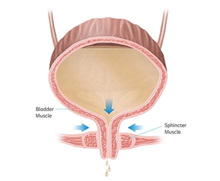 How does the bladder work and what causes bladder leakage