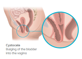 Learn More About Pelvic Organ Prolapse Symptoms Treatments