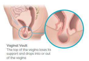 Diagram of Vaginal Vault Pelvic Organ Prolapse