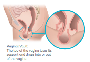 Pussy Prolapse