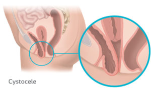 Diagram of Cystocele Pelvic Organ Prolapse