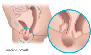 Diagram of Vaginal Vault Pelvic Organ Prolapse