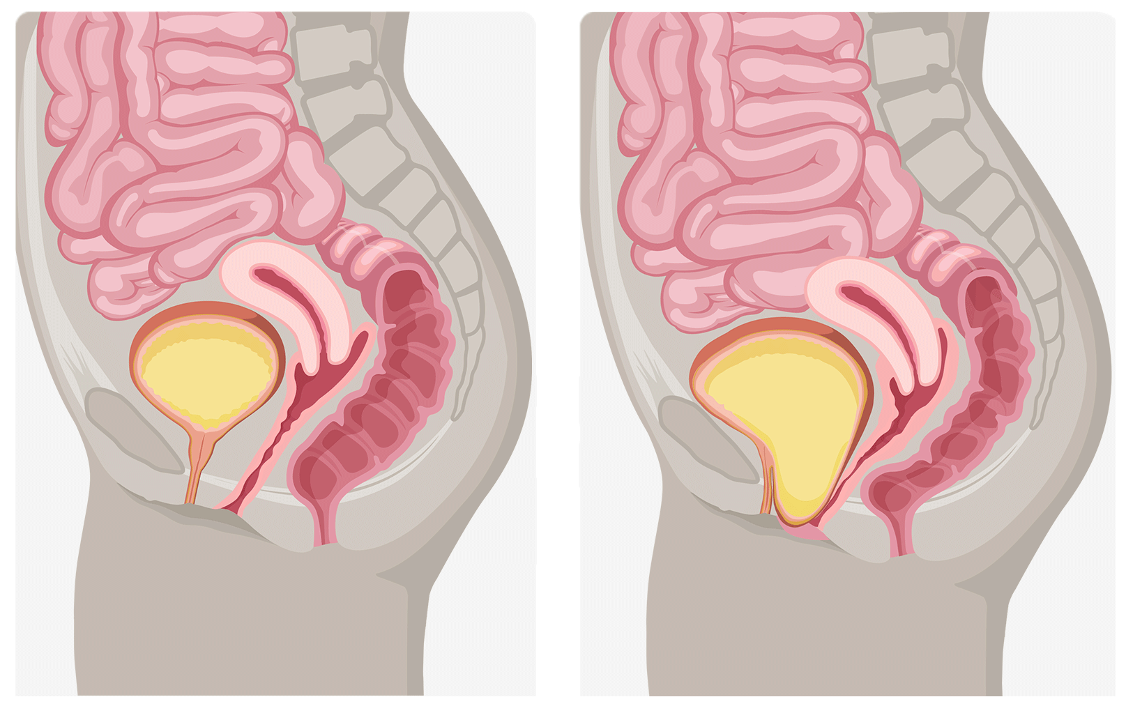 A Cystocele is Also Known As a Bladder Prolapse, a Fallen Bladder, a Prolapsed  Bladder, or an Anterior Vaginal Prolapse Stock Illustration - Illustration  of infection, cancer: 272796958