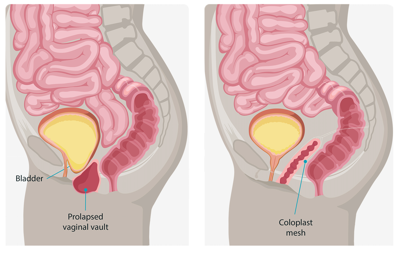 Surgical solutions for prolapse