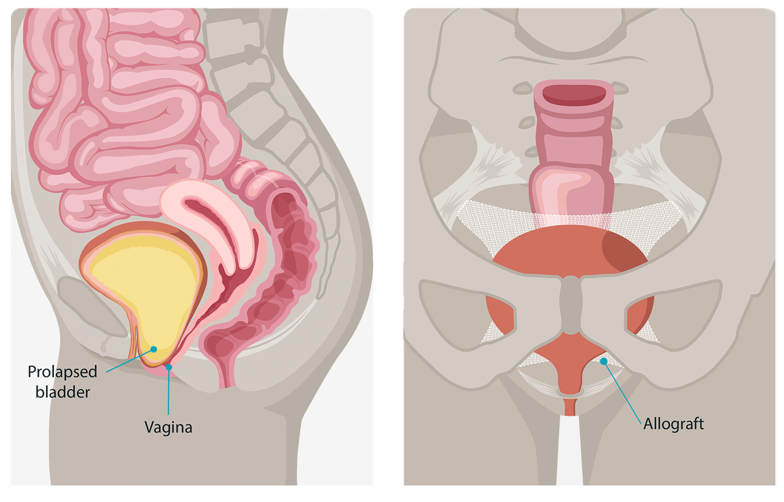 Surgical solutions for prolapse