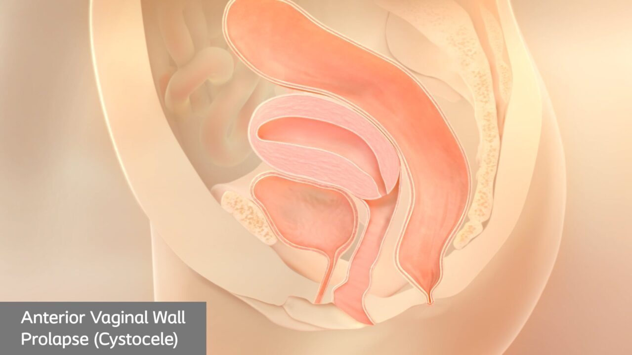 cystocele pop animation thumb