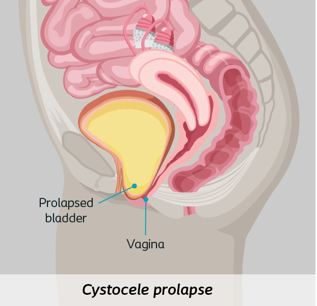 cystocele prolapse
