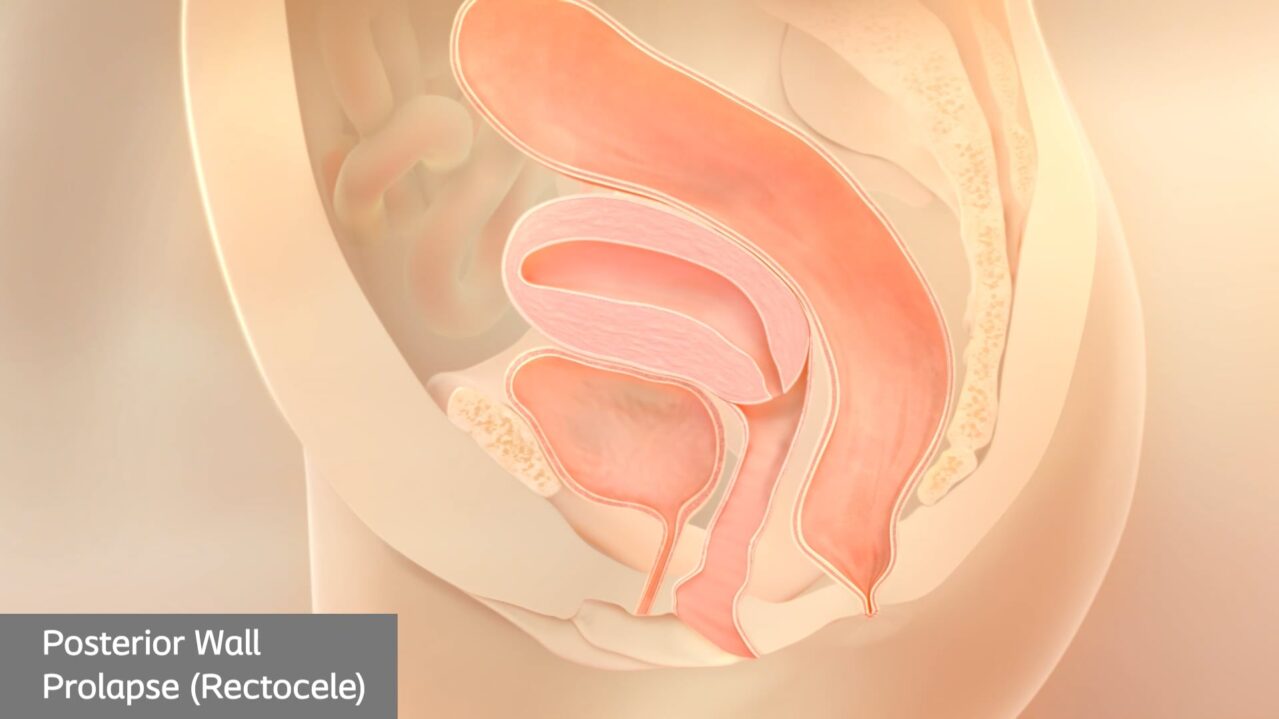 rectocele pop animation thumb