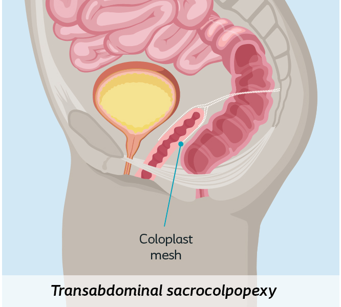 transabdominal pop approach