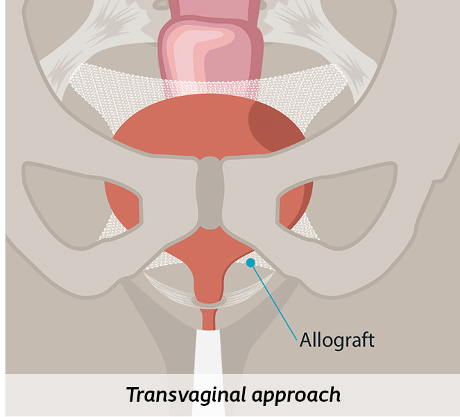 transvaginal-pop-approach