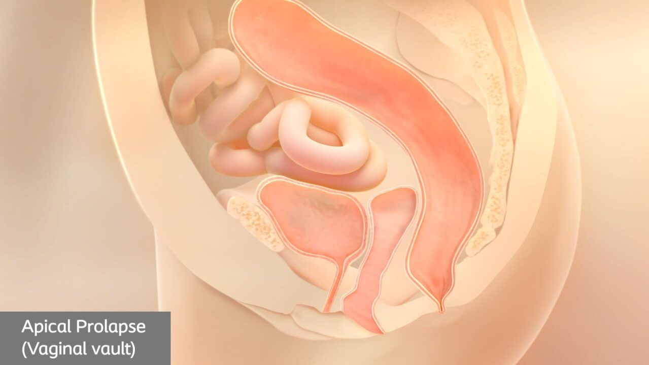 vag vault pop animation thumb