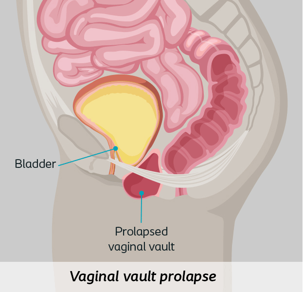 vaginal vault prolapse